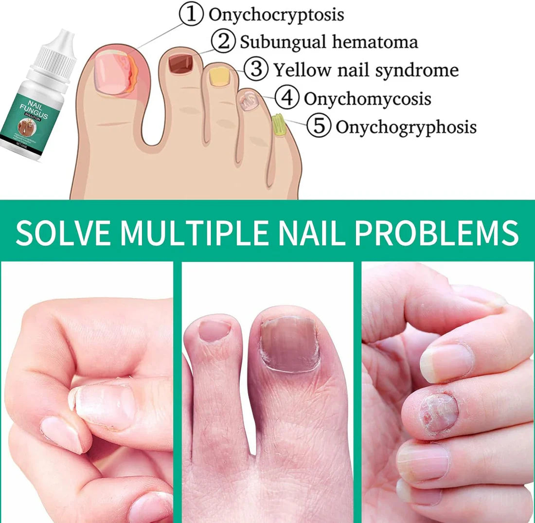 Nexusdrop Nail Fungus Solution